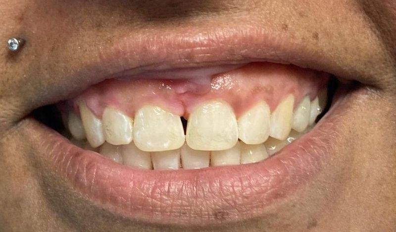 After Closing spaces with clear aligners