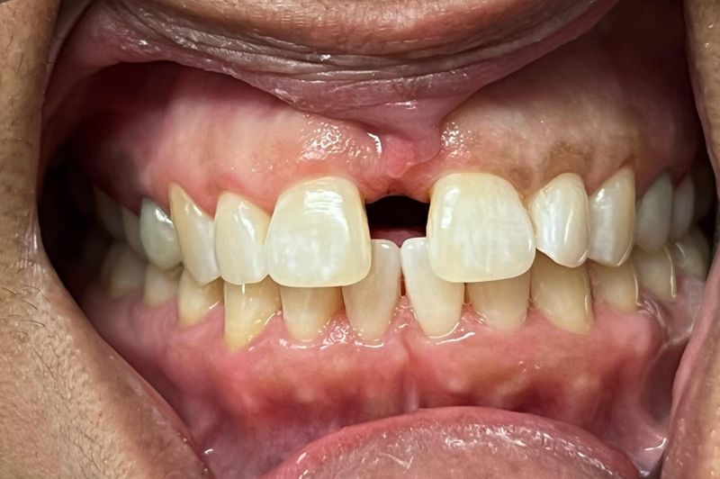 Before Closing spaces with clear aligners