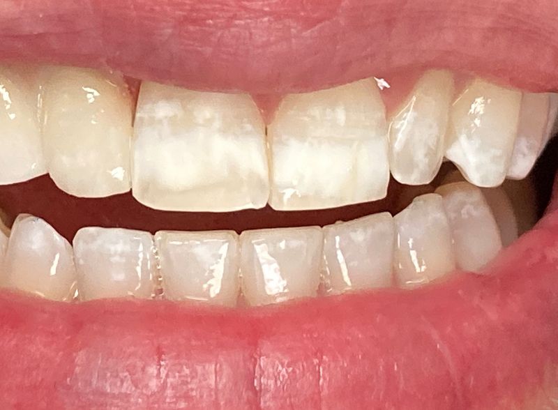 After Two-unit dental bridge