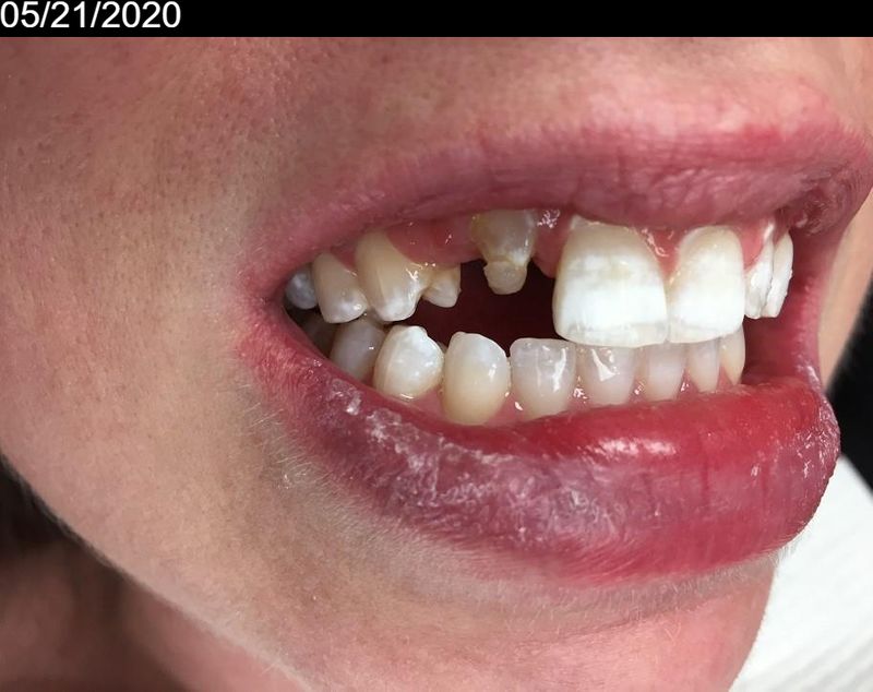 Before Two-unit dental bridge