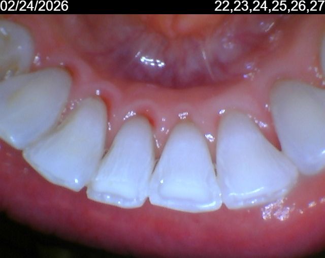 After Calculus removal and professional cleaning