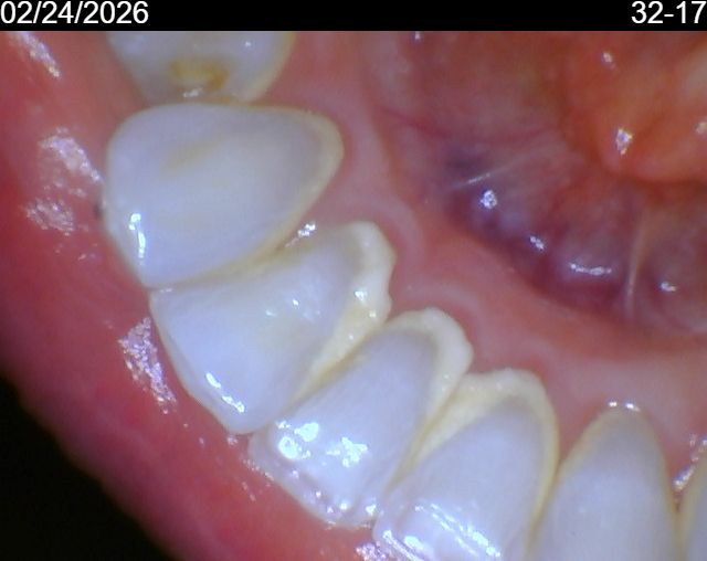 Before Calculus removal and professional cleaning
