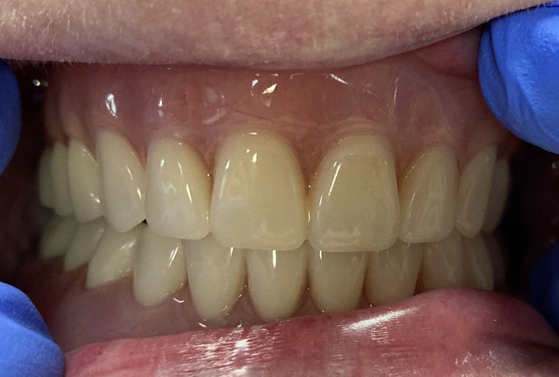 After Complete upper and lower dentures