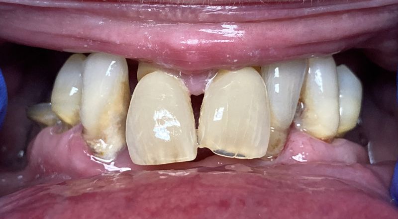 Before Complete upper and lower dentures