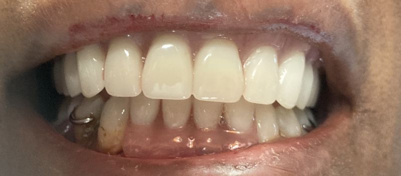 After Complete upper denture and lower partial denture