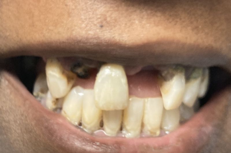 Before Complete upper denture and lower partial denture